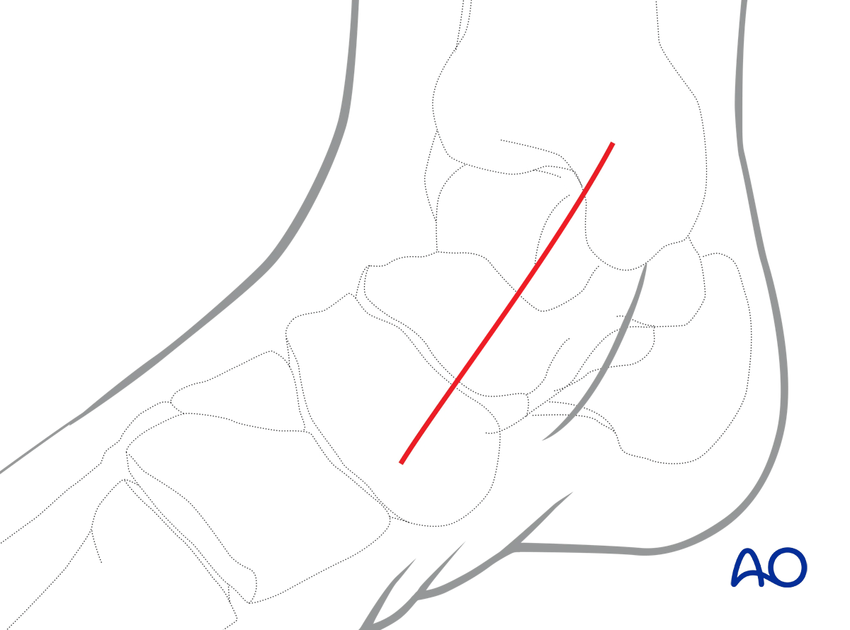 Illustration of anteromedial approach to the talus