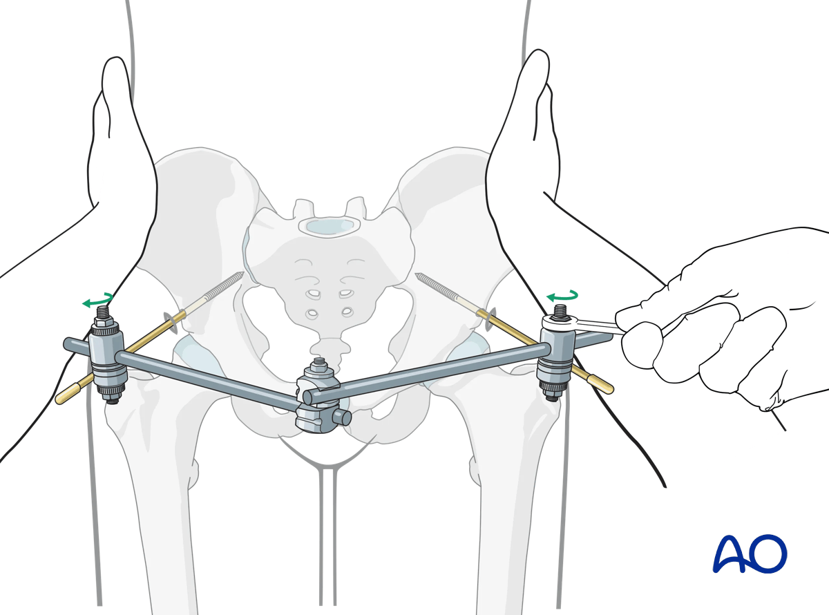 Stabilization of the pelvic ring using a large external fixator