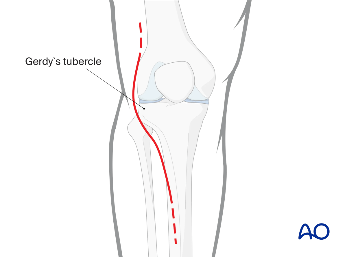 Anterolateral approach to the proximal tibia: skin incision