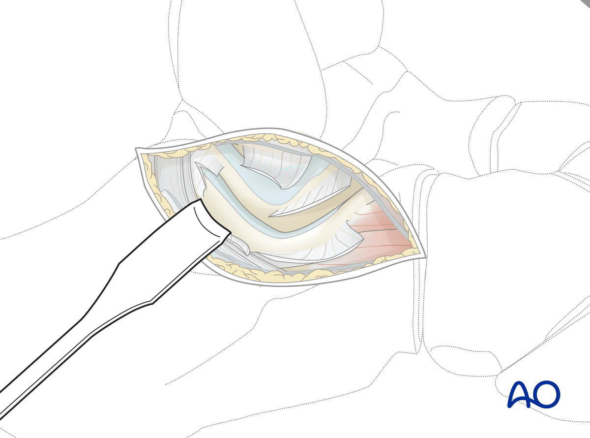 Sinus tarsi approach to the calcaneus exposing the subtalar joint via joint capsule incision