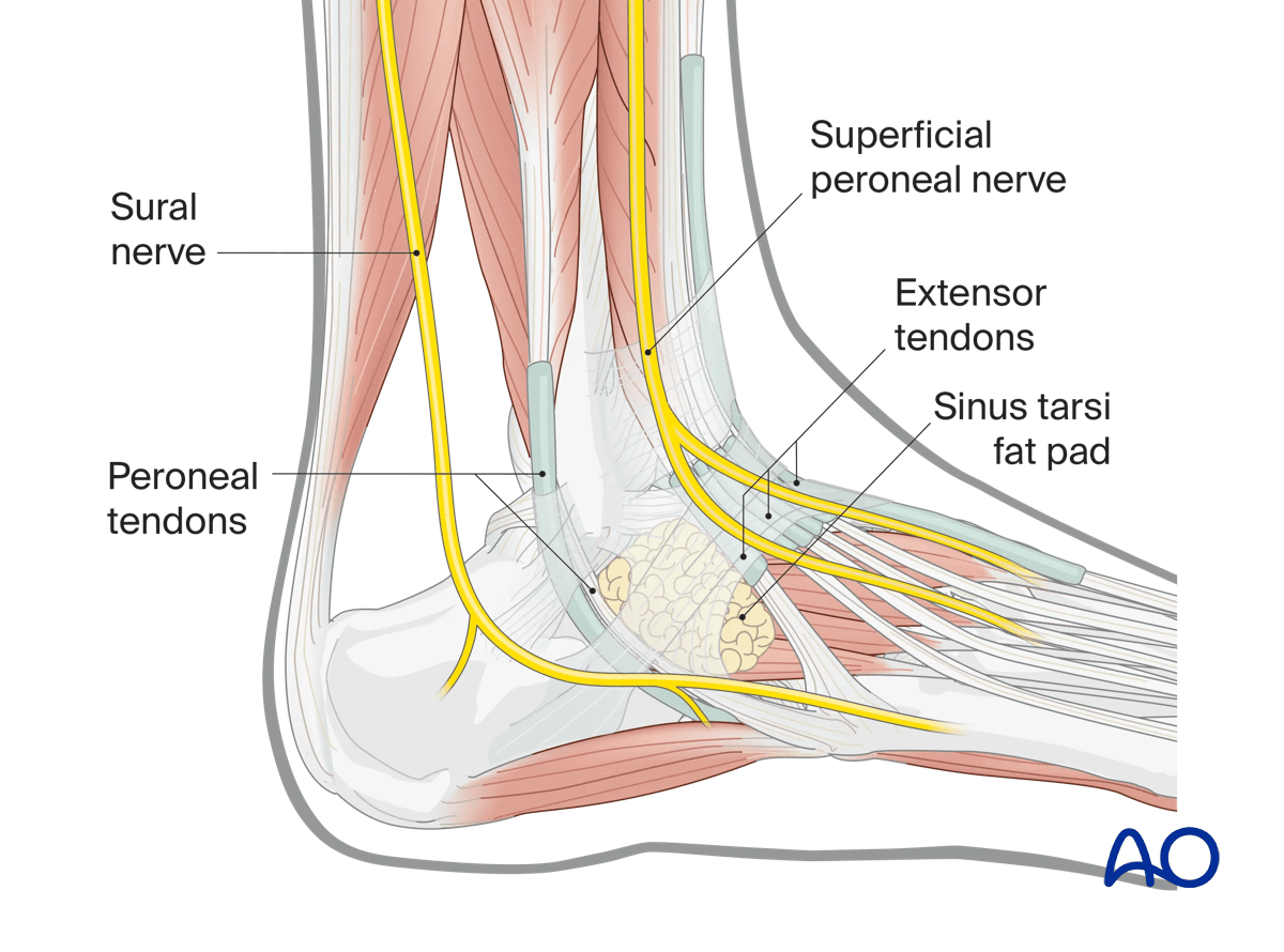 Direct lateral talus approach peroneal tendons posterior/lateral and extensor tendons anterior/dorsal; fat pad to subtalar joint