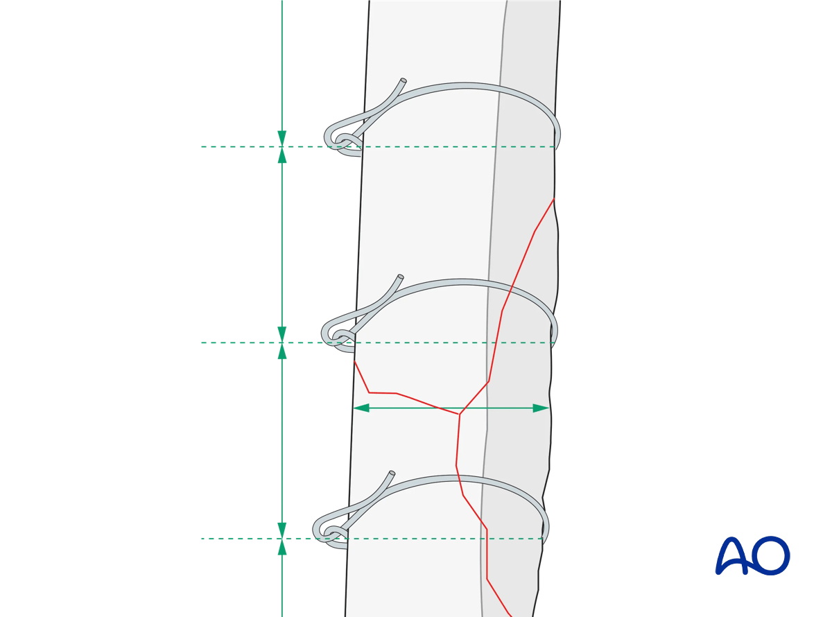 The distance between the cerclage wires must be at least 0.5 bone diameter away from the tip of the fragment
