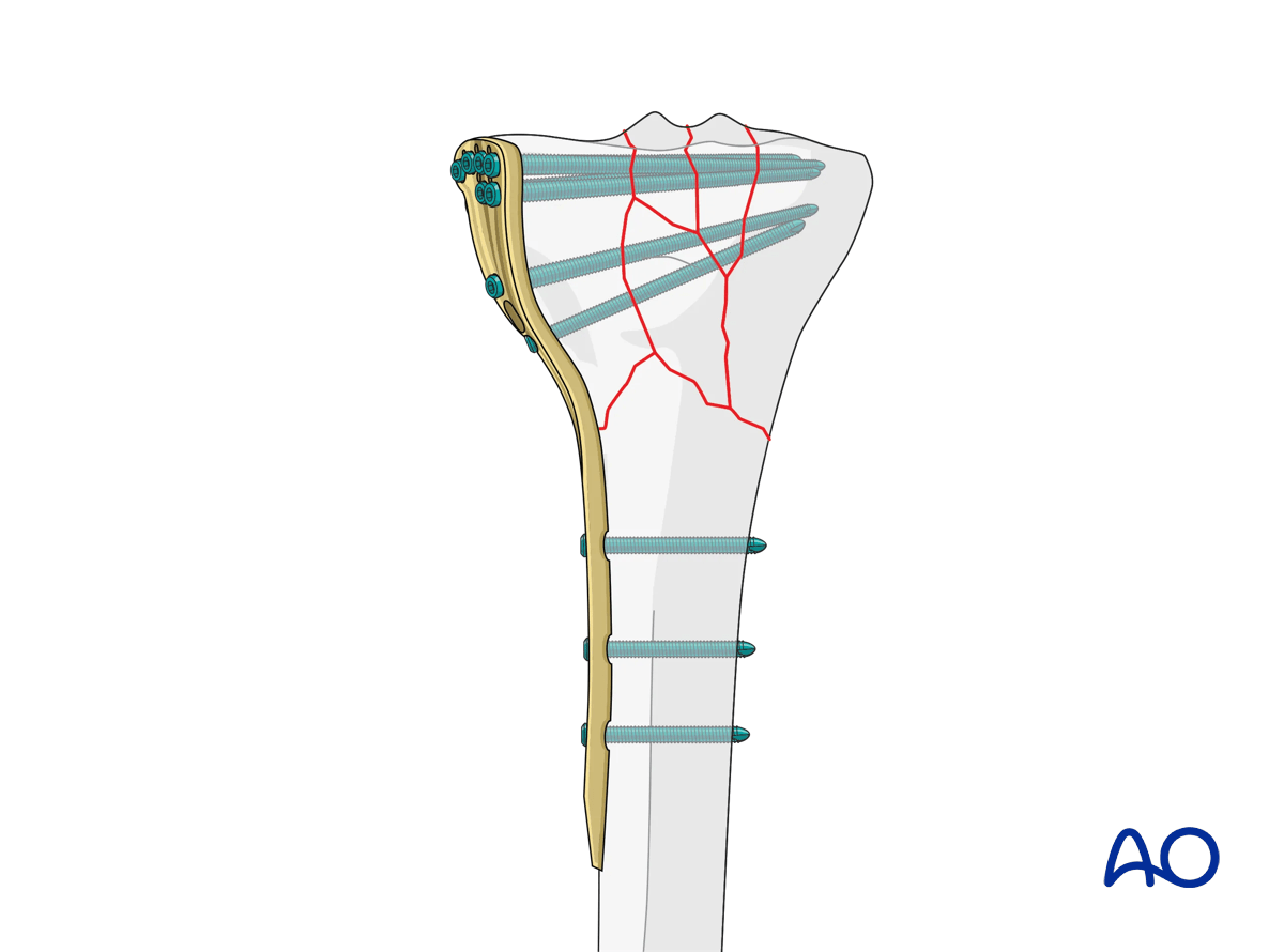 Proximal tibia: complete articular fracture - Angular stable plating