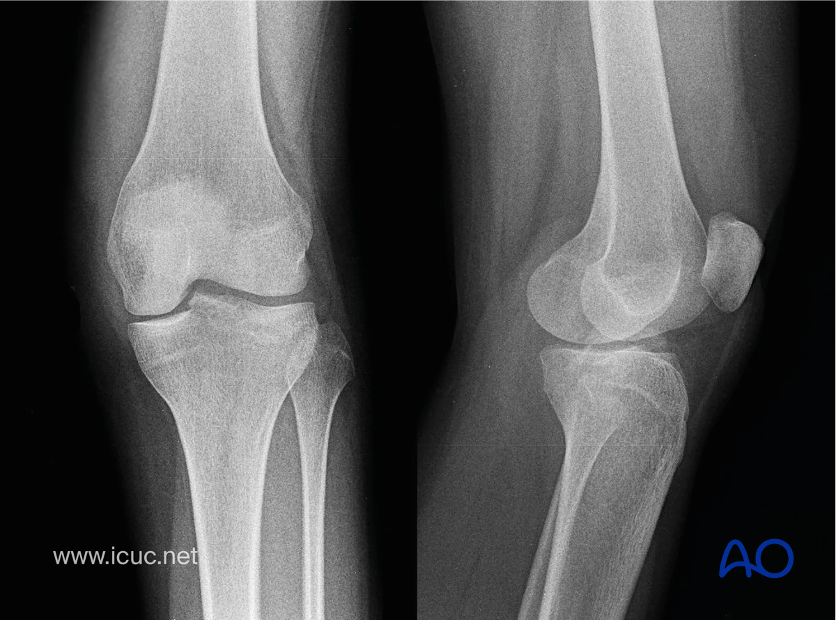 AP and lateral x-rays demonstrating avulsion of the tibial spine with slight displacement