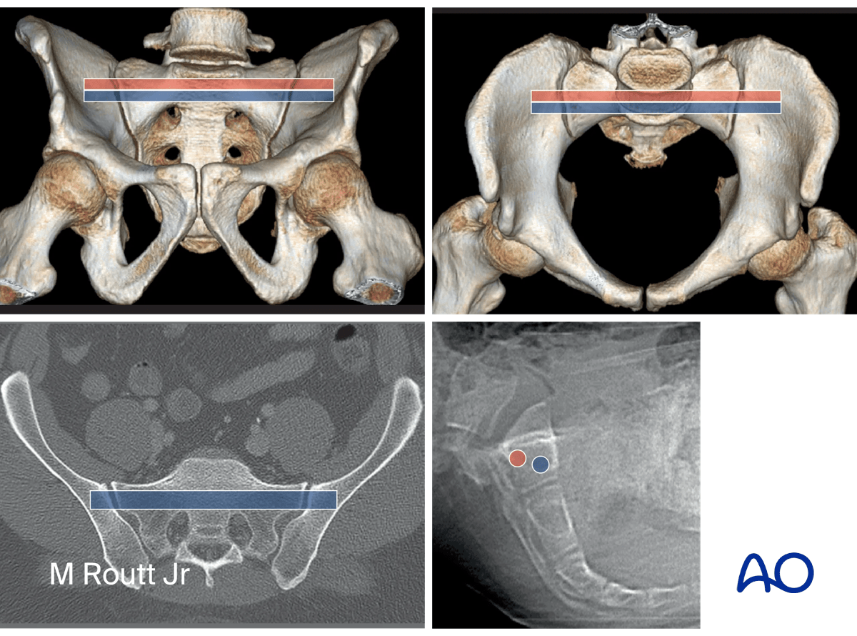 Planning for IS screw insertion