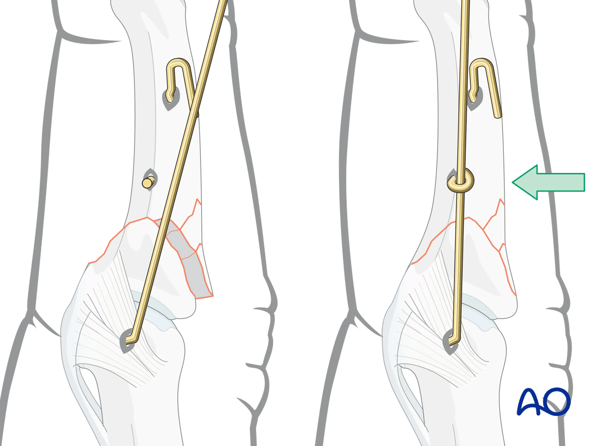 Dynamic external fixation: Insert third 1.0 mm K-wire in middle phalanx to control dorsal dislocation forces on PIP joint.