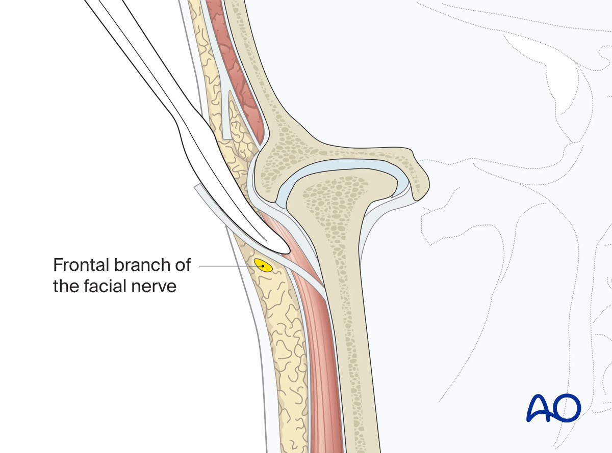 Endaural approach to condyle: Coronal view of the dissection