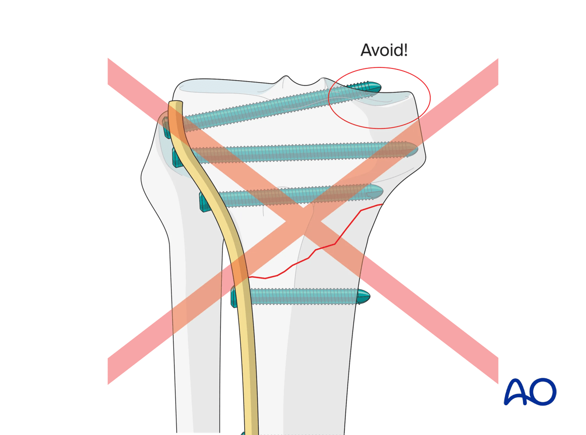 Proximal tibia: Simple extraarticular fracture of the metaphysis Angular stable plating – positioning of the plate
