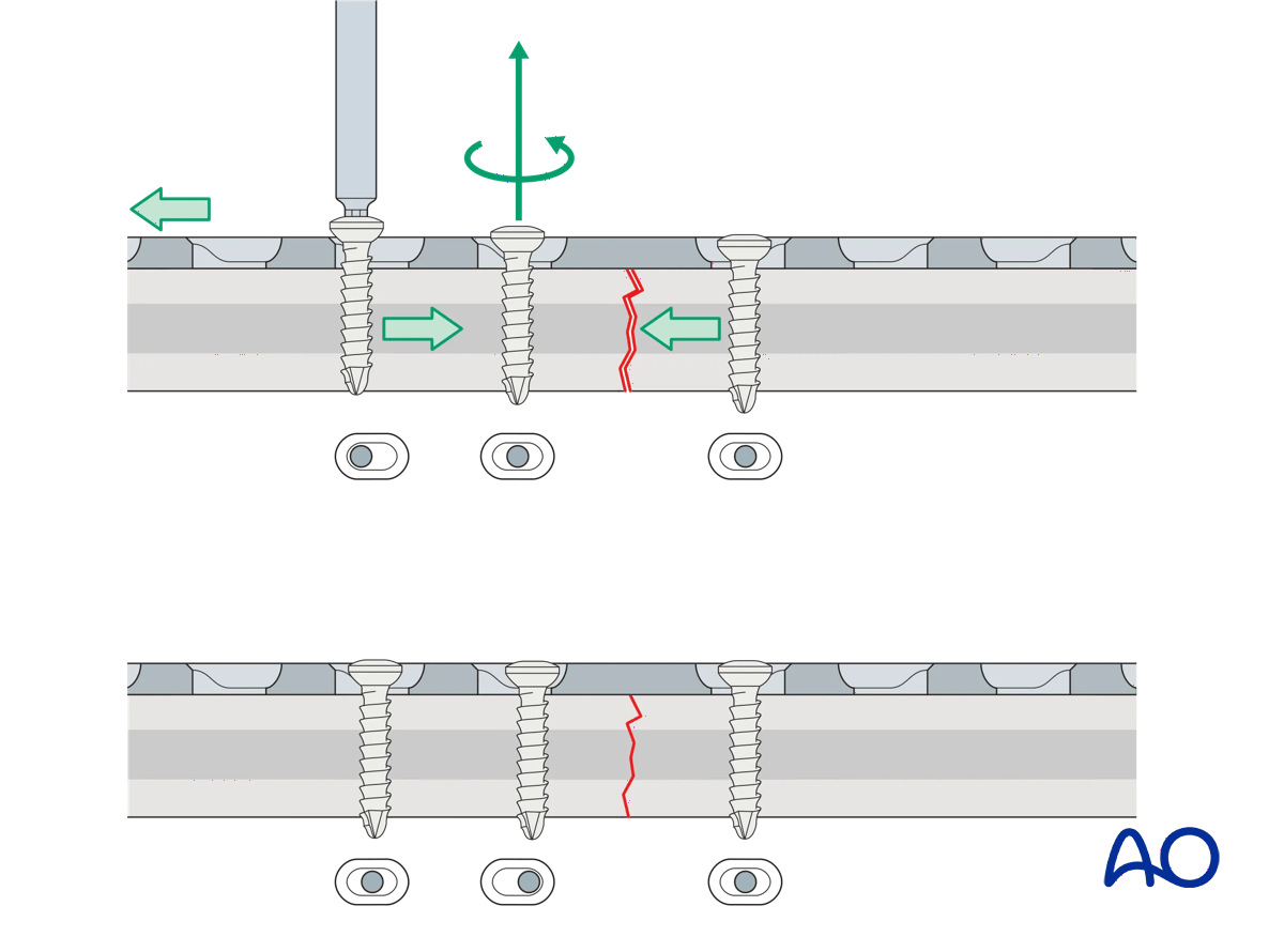 Illustration showing the insertion of a third compression screw to close a fracture gap, with steps to loosen and re-tighten screws.
