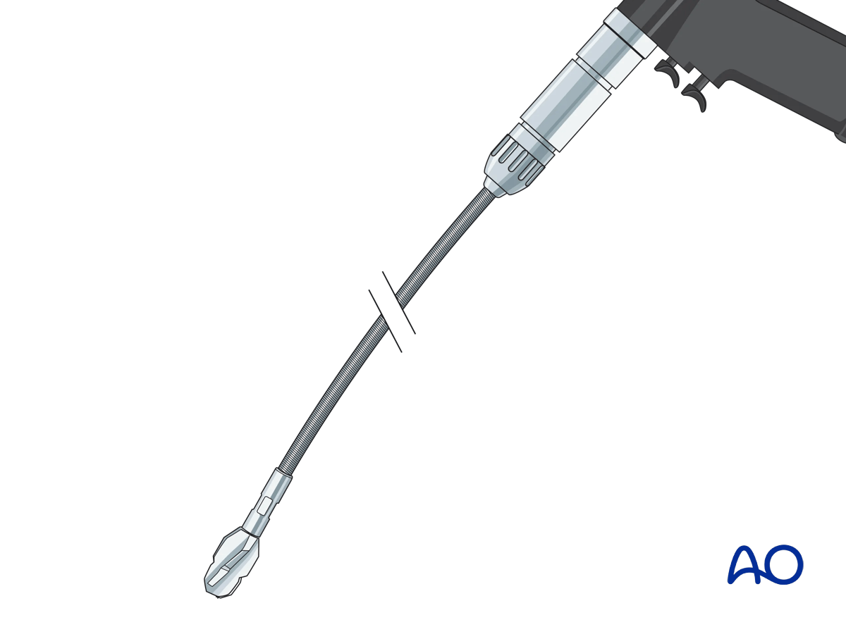 Suprapatellar intramedullary nailing,
