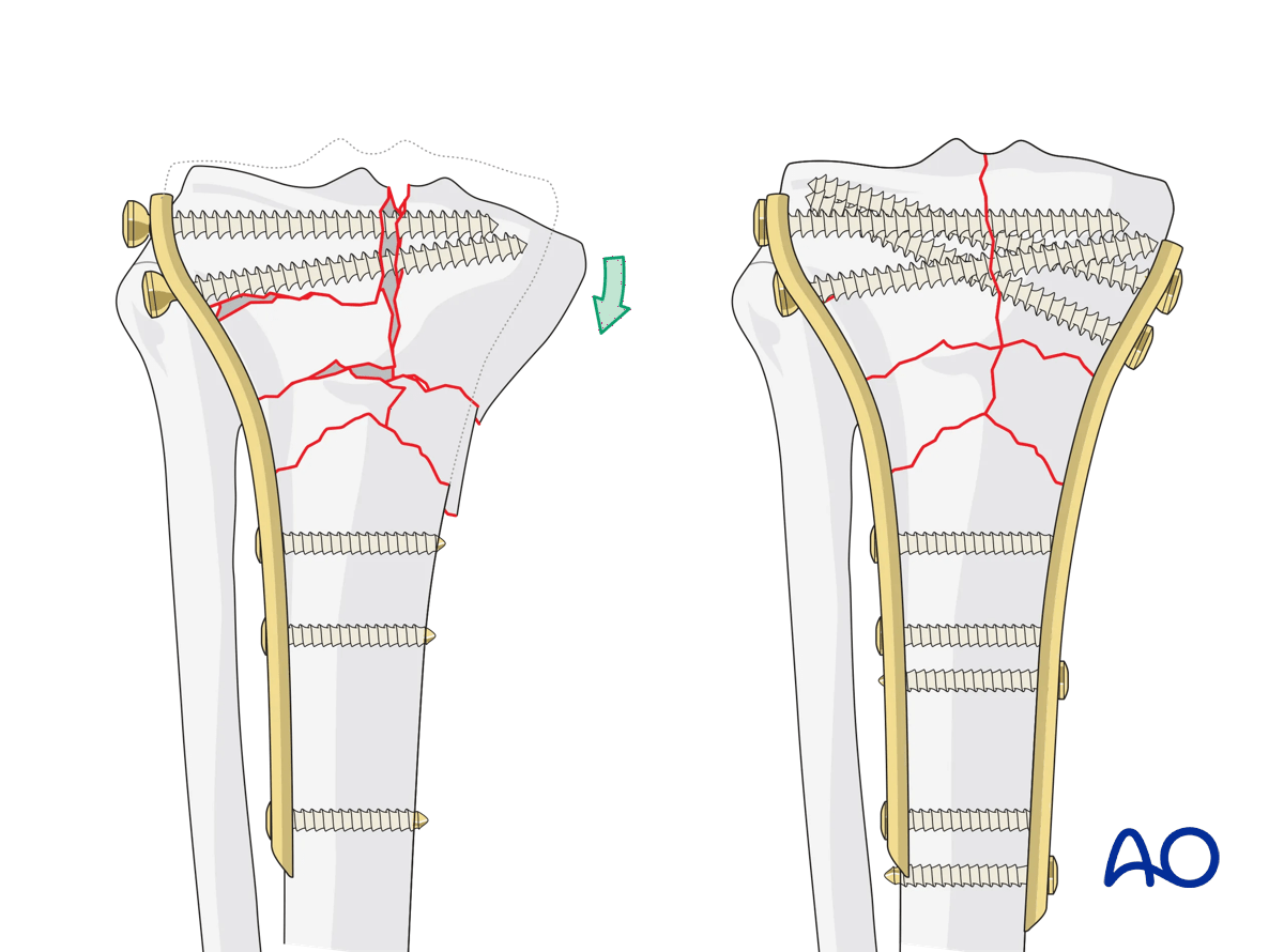 omplete simple articular fracture with fragmentary metaphyseal components: double plating