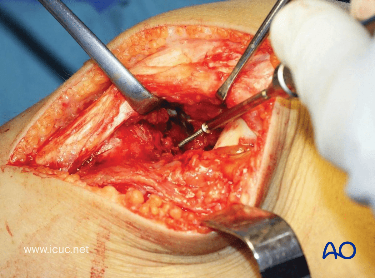 Avulsion of tibial spine – A second lag screw is inserted