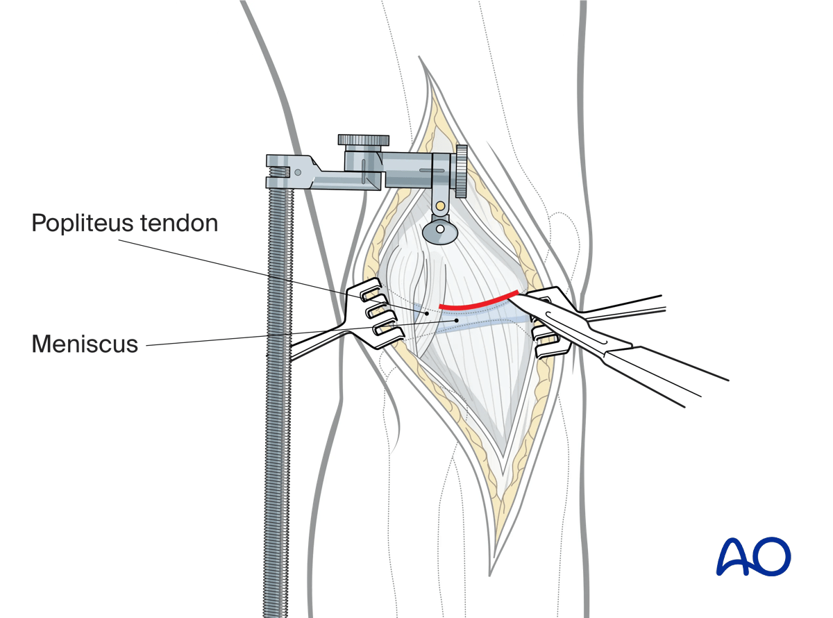 Extended anterolateral approach to the proximal tibia: transverse suprameniscal capsular incision