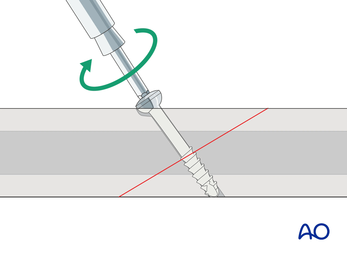 Insertion of self-tapping screw