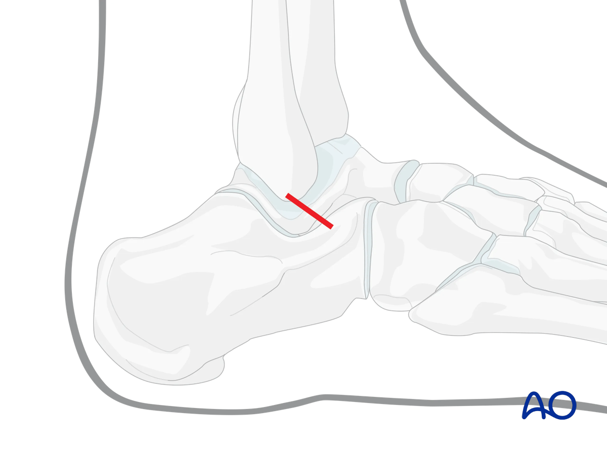 Direct lateral talus approach, similar to mid-portion of the anterolateral approach
