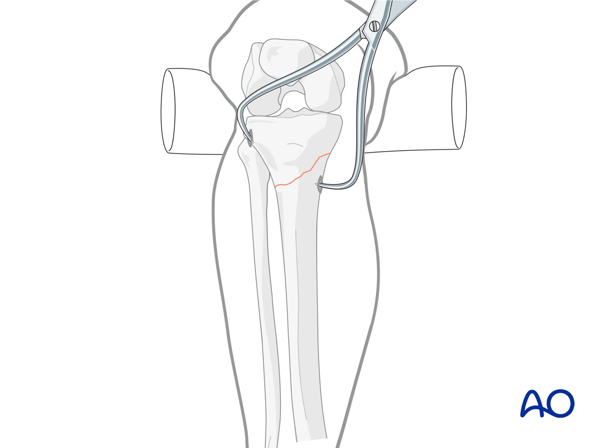 Proximal tibia: Simple extraarticular fracture of the metaphysis Angular stable plating - reduction