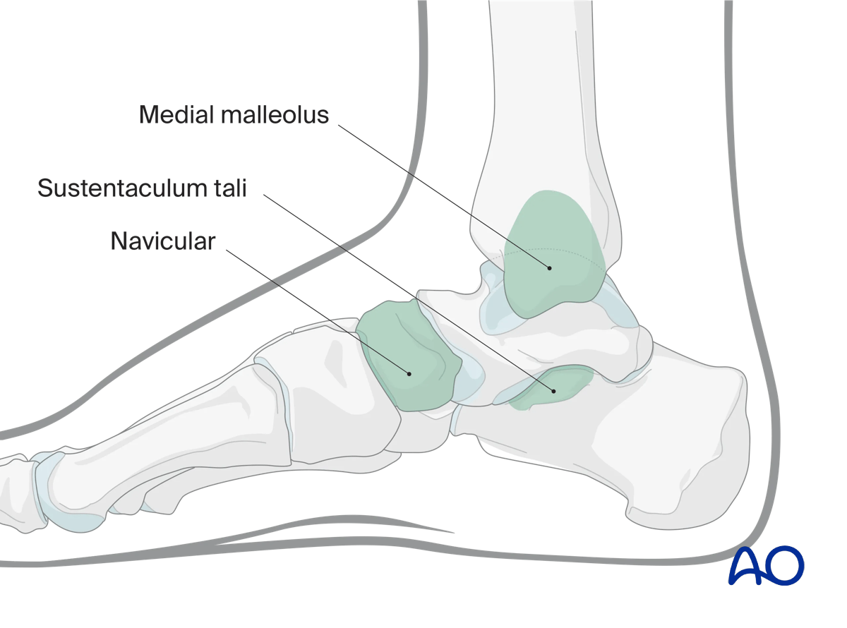 Sustentaculum tali palpable landmark in medial approach to the calcaneus