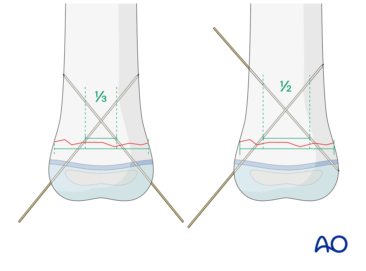 K-wires crossing a transverse metaphyseal fracture