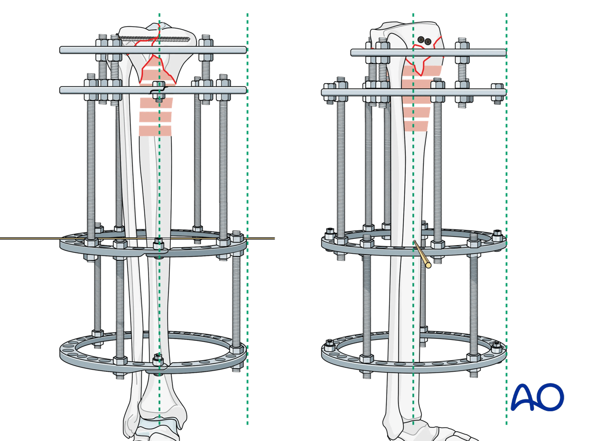 Proximal tibia fracture – ring fixation: placement of diaphyseal fixation block