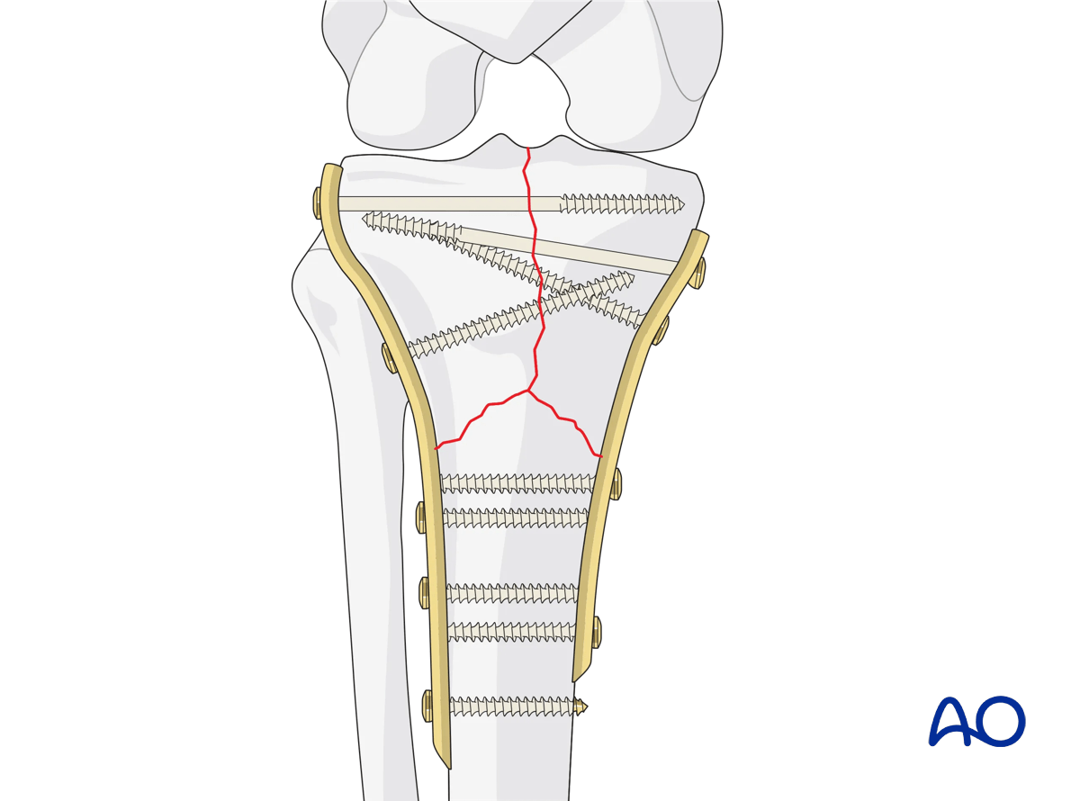 Proximal tibia: Complete simple articular fracture with simple metaphyseal components: ORIF Conventional plating – final construct