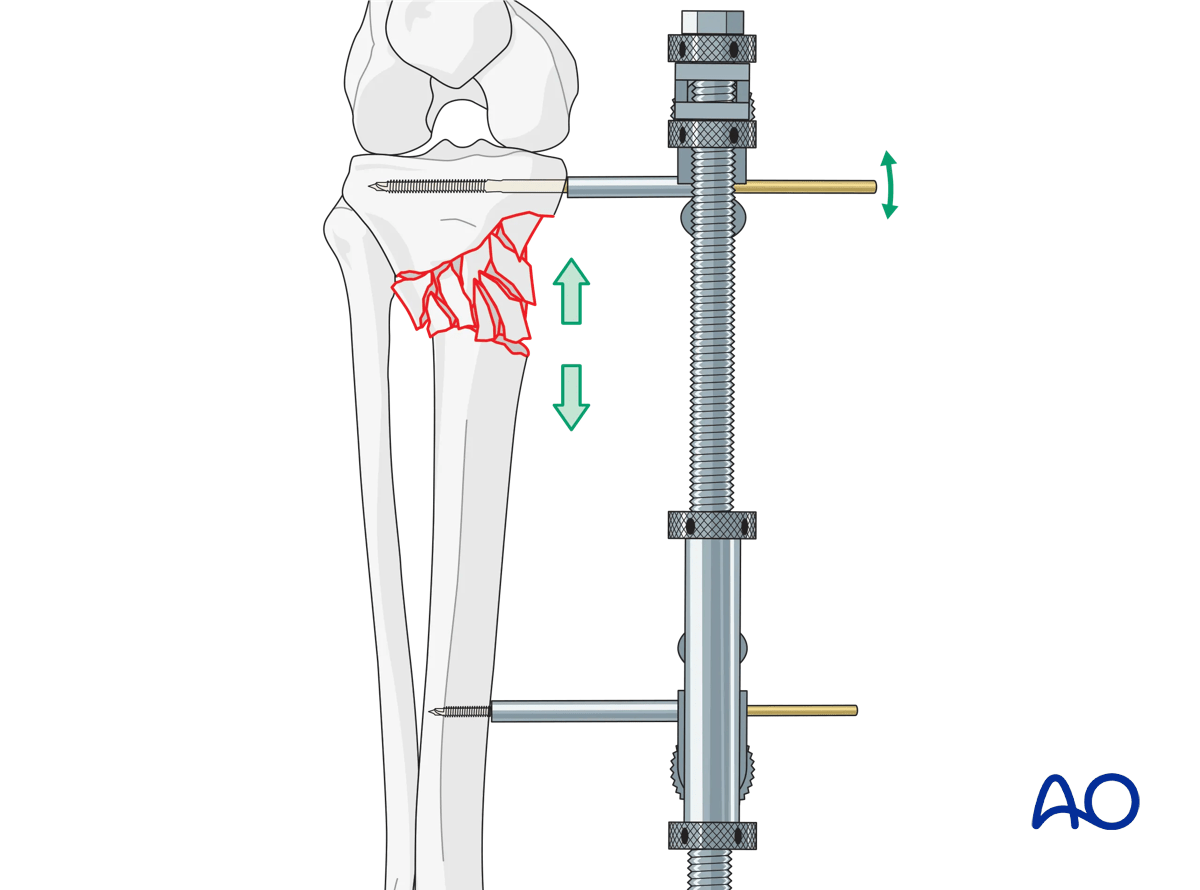 ORIF - Conventional plating, secure reduction