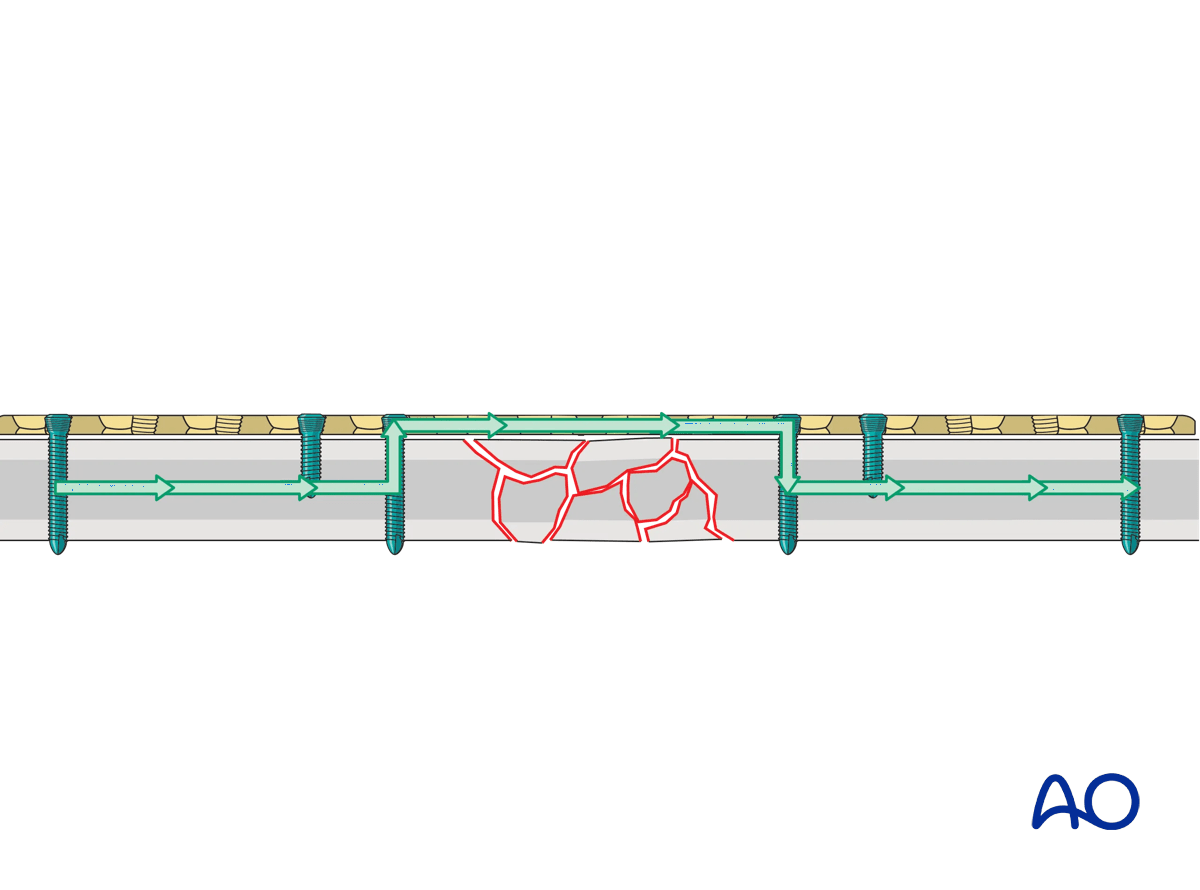 Load-bearing implant