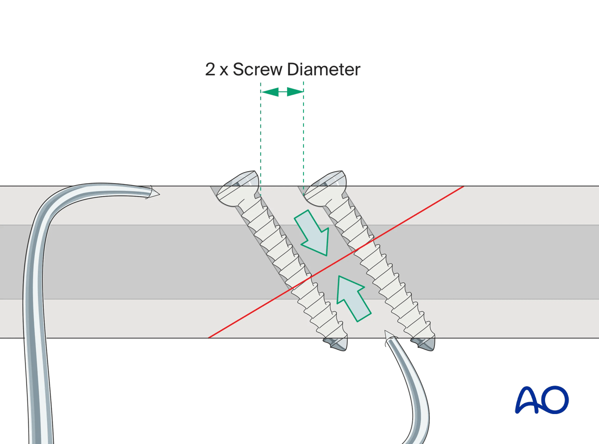 Care must be taken not to place two lag screws too close to each other.