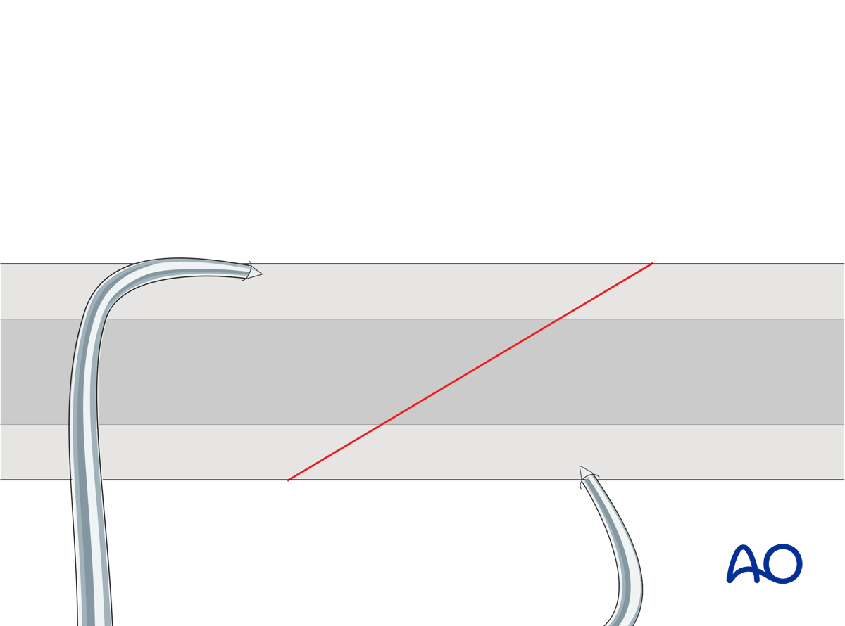 Reduction and temporary fixation