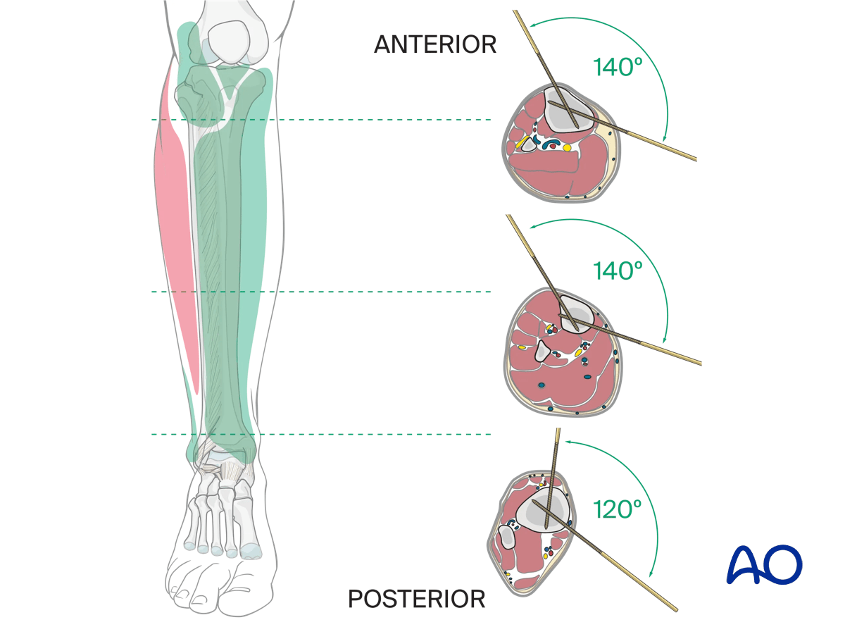 Safe zones in the tibia for wire and Schanz screw insertion