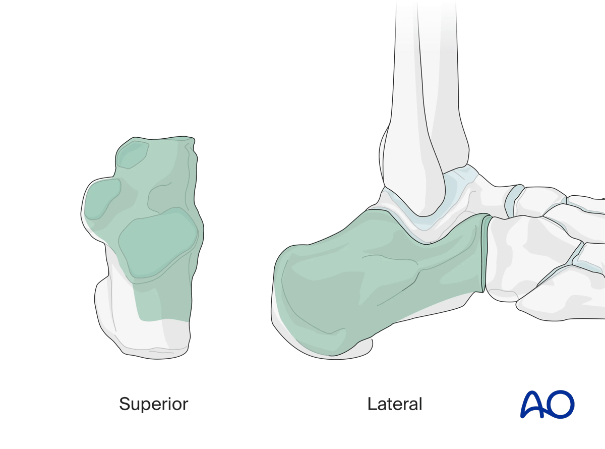 Extended lateral approach to the calcaneus visualizes calcaneus areas for fracture reduction