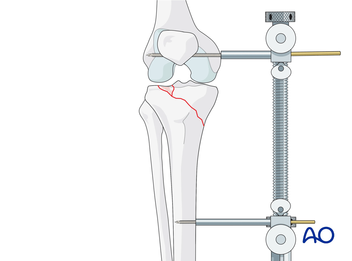 ORIF - Conventional plating, final osteosynthesis, femoral distractor