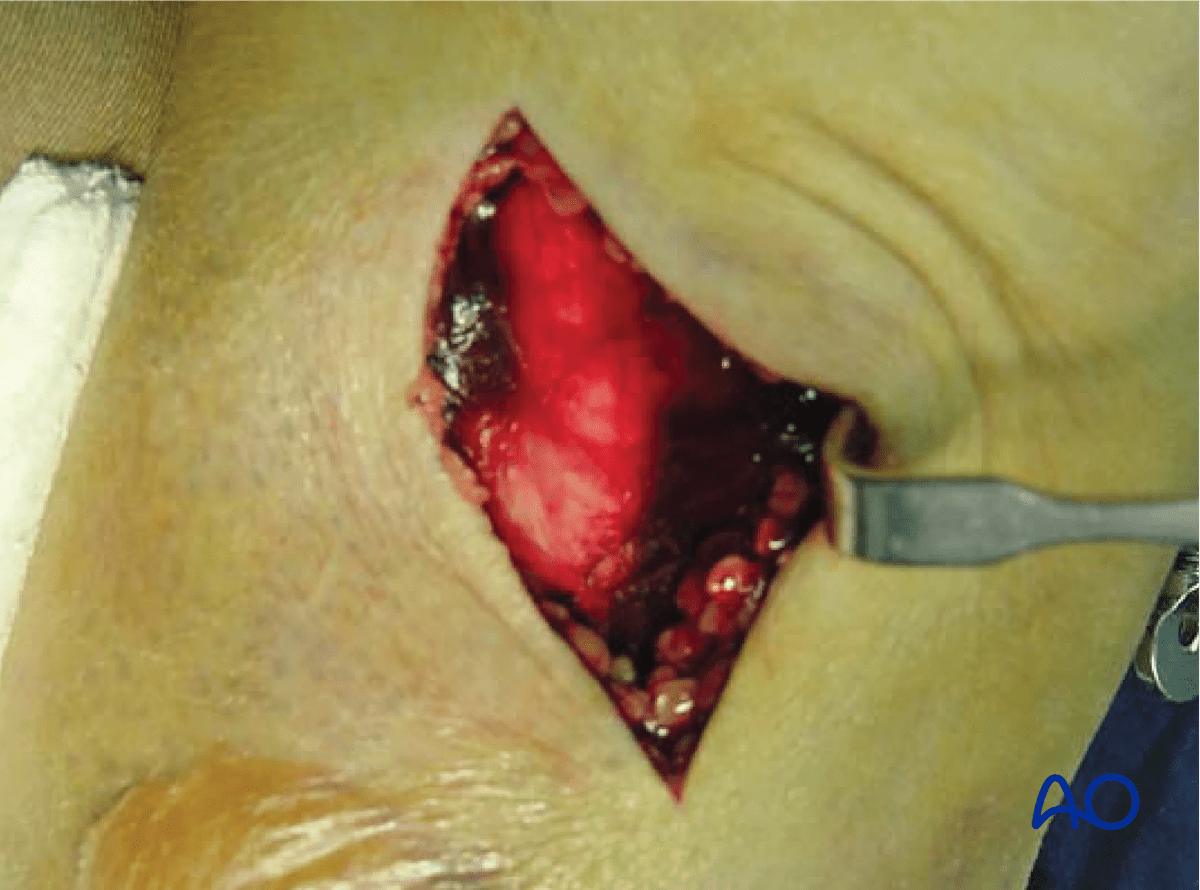 Approach for minimally invasive osteosynthesis (MIO) of the proximal tibia, opening the fascia
