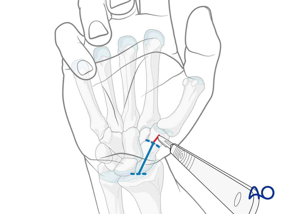 Minimally invasive palmar approach to the scaphoid