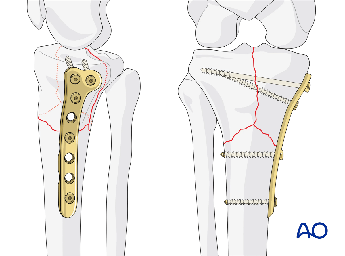 Complete simple articular fracture with simple metaphyseal components: ORIF Conventional plating – medial column fixation