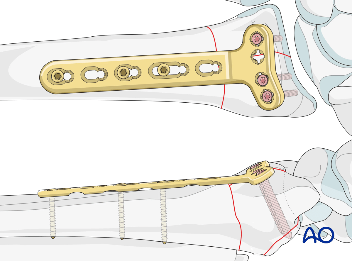 Plate fixation of a complete articular distal radius fracture