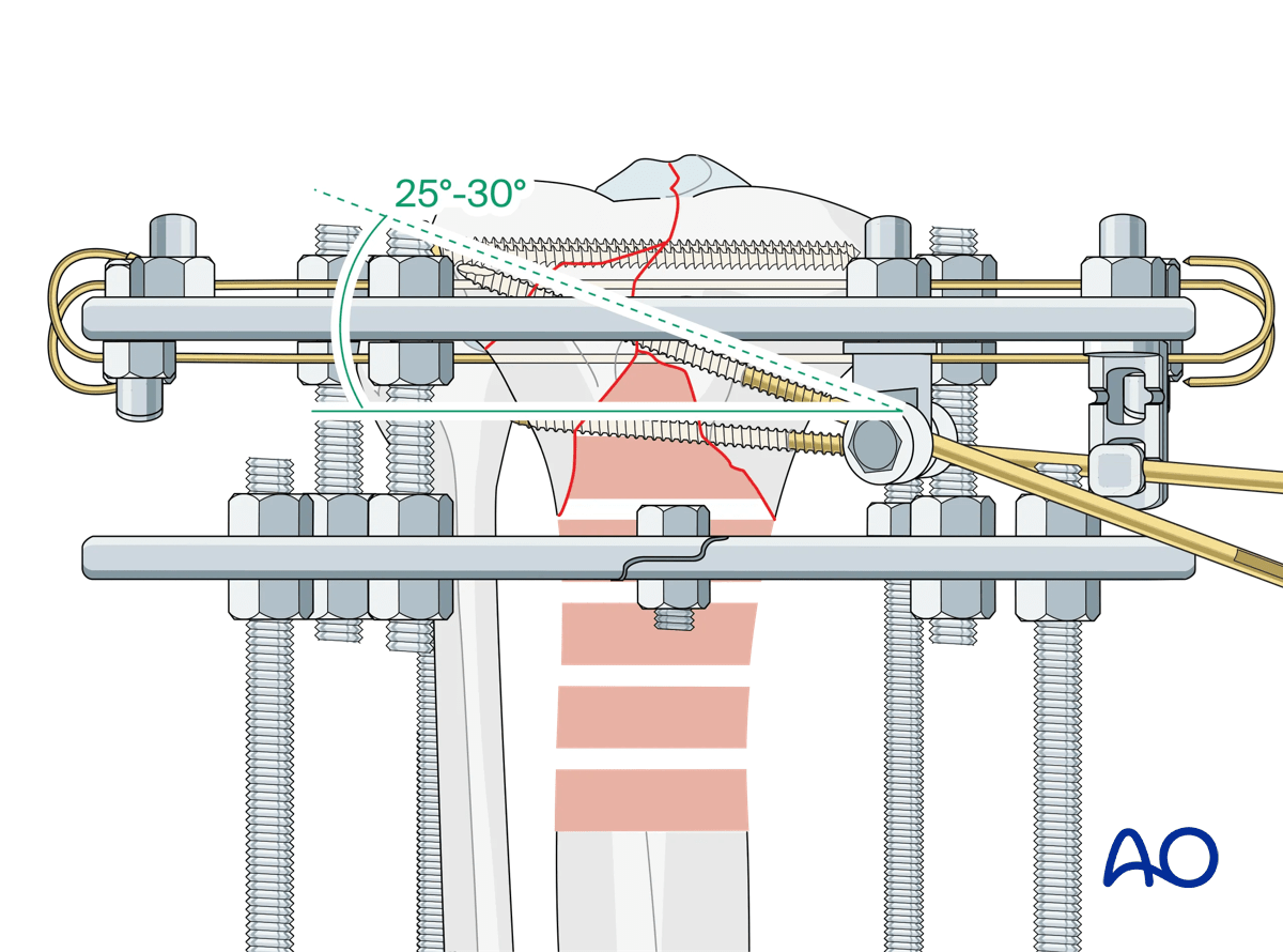 Proximal tibia fracture – ring fixation: placement of additional Schanz screws