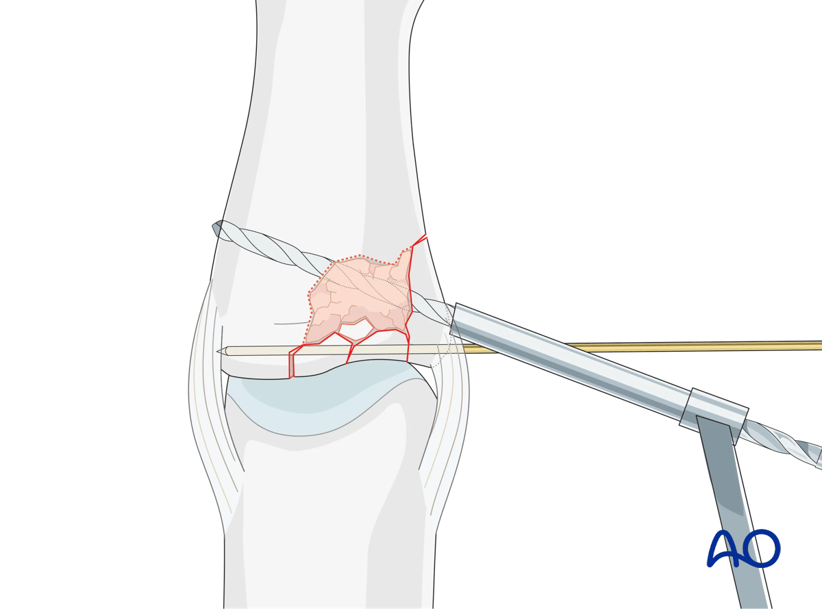 Joint reconstruction of lateral plateau fracture in middle phalangeal base, use position screw or K-wire, drill threaded hole.