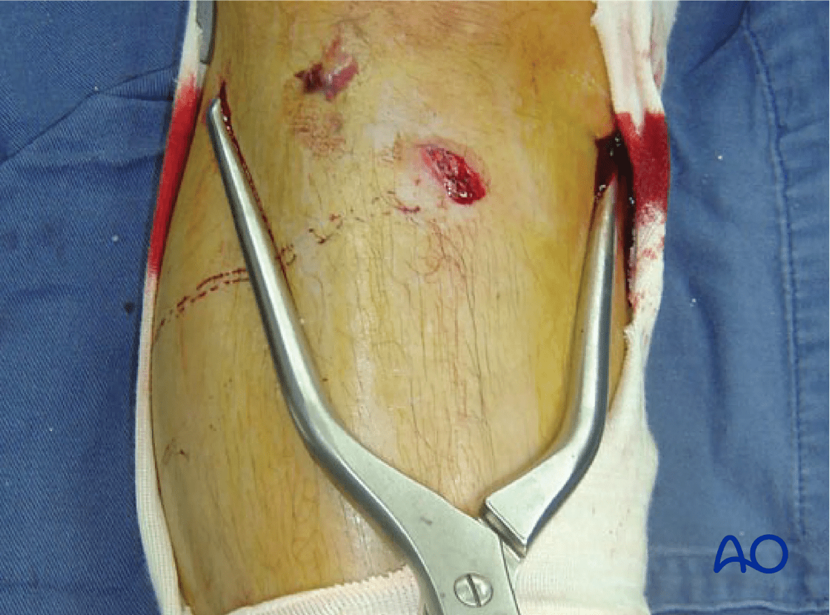 Proximal tibia fracture – clinical image showing clamp application