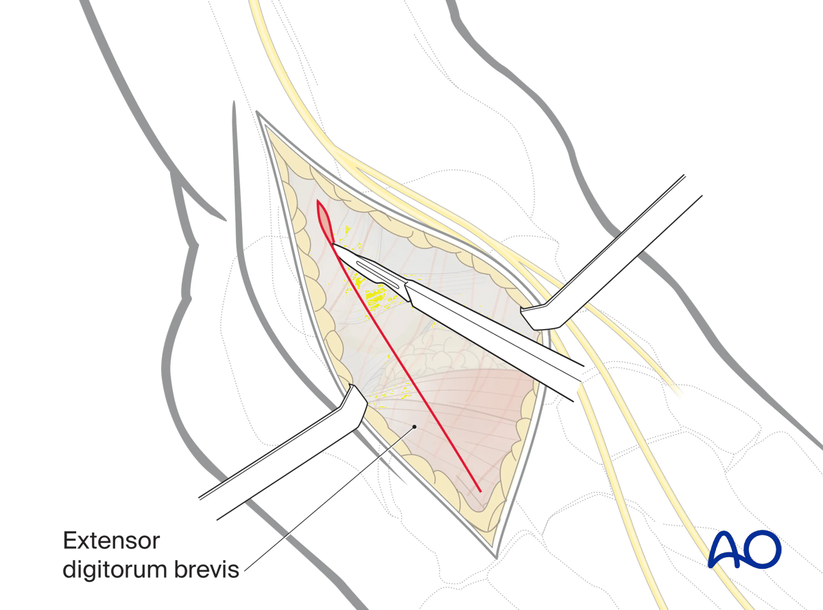 Divide deep fascia and extensor retinaculum to expose extensor digitorum brevis anterolateral approach