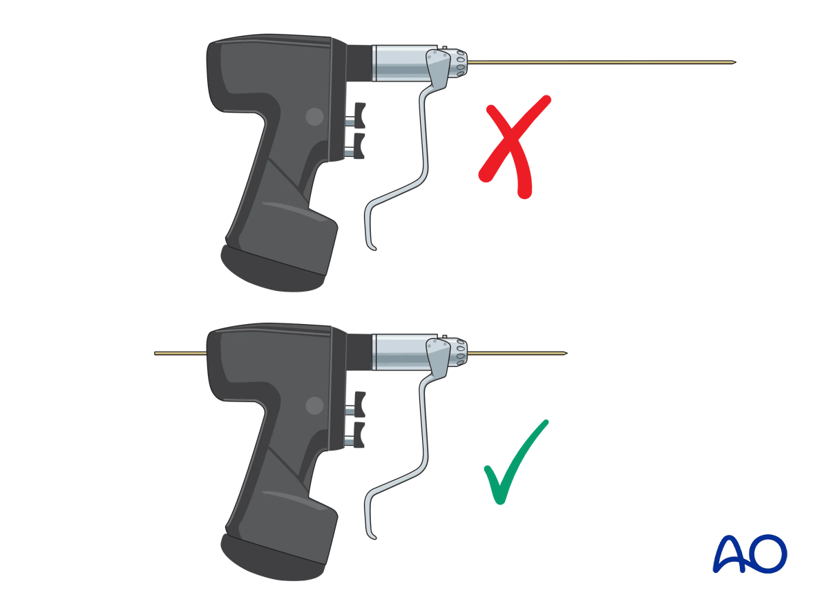 Reduced length of the K-wire protruding from the drill