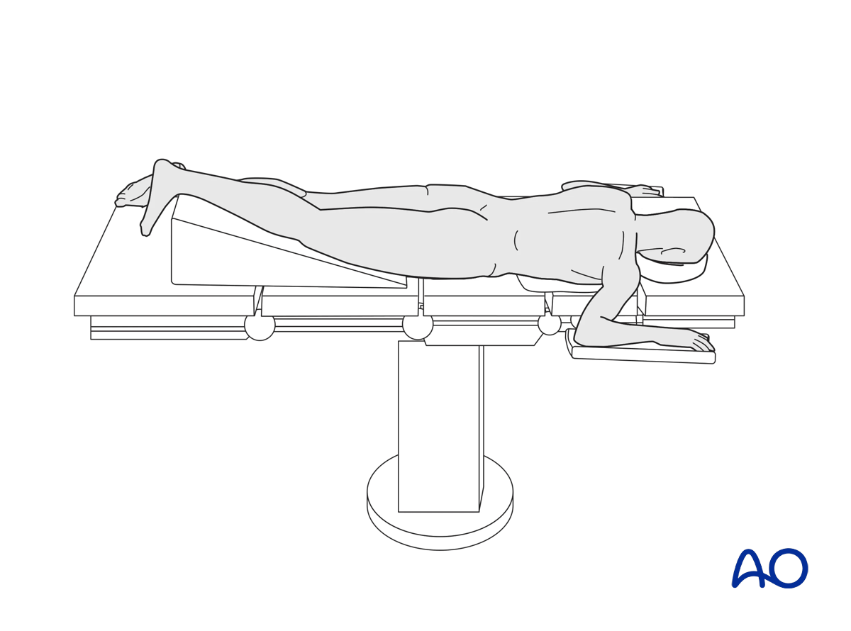 Prone posteromedial approach to the proximal tibia, prone positioning