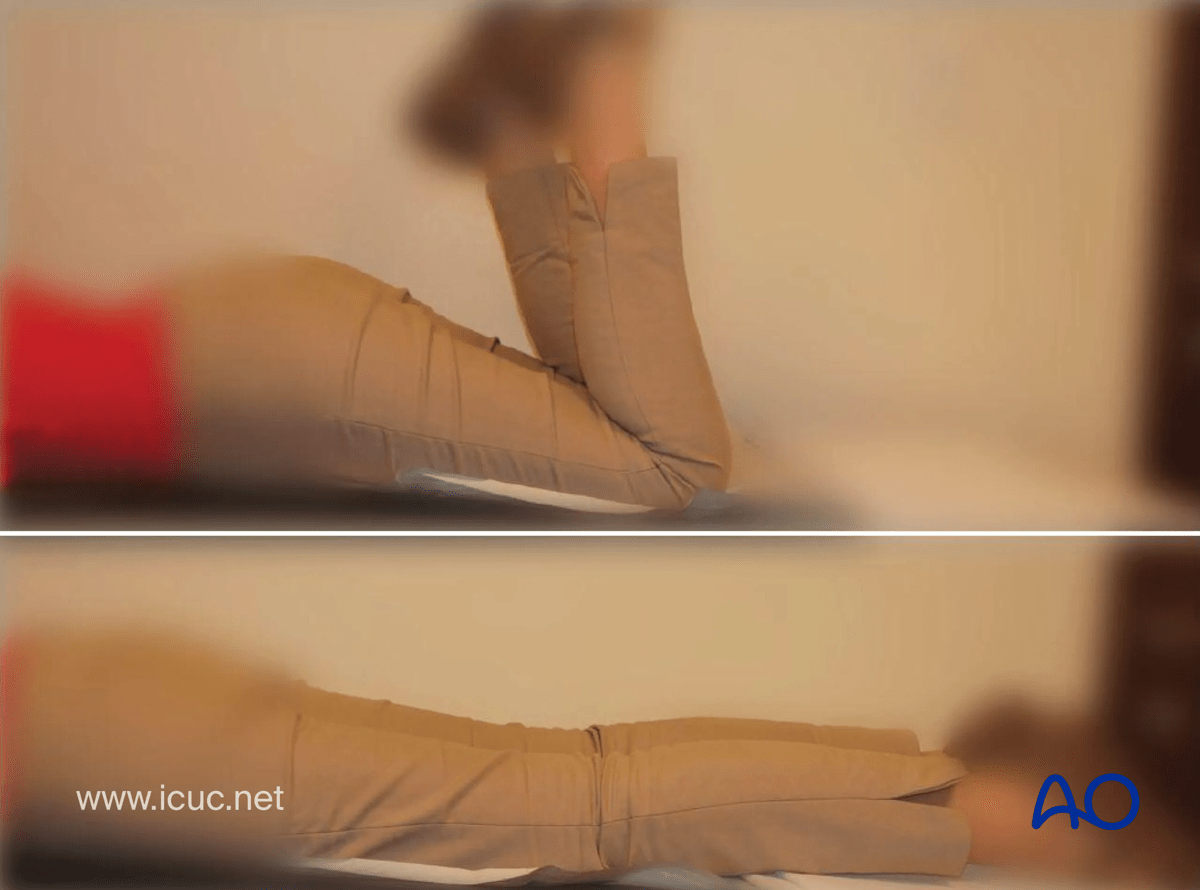 Avulsion of tibial spine – One-year images showing maintenance of flexion and full extension of the knee