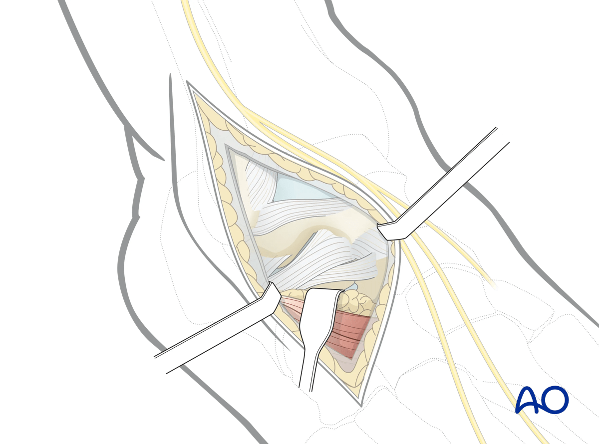 Retracted extensor digitorum brevis revealing the lateral aspect of the talar neck for exposure anterolateral approach