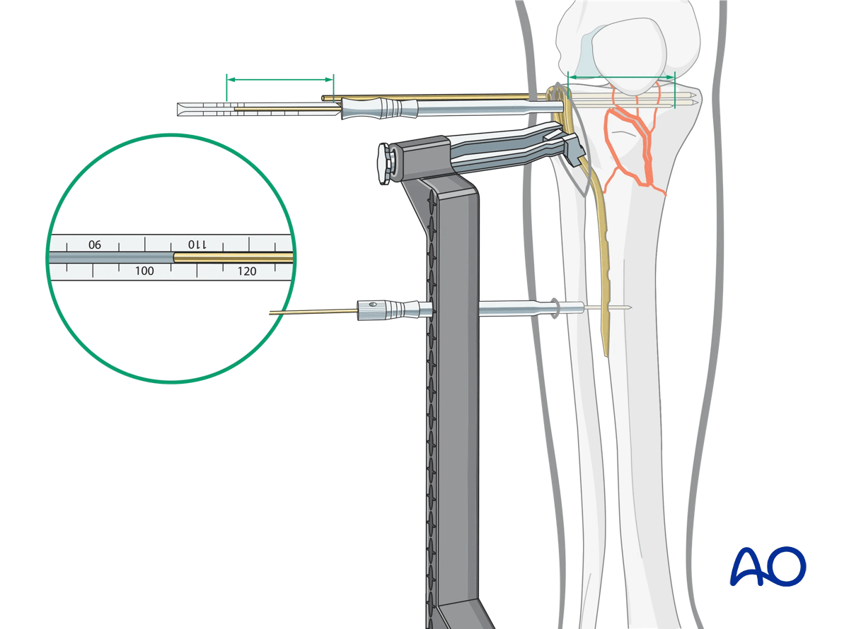 Proximal tibia: complete articular fracture - Angular stable plating – finalized reduction and screw placement