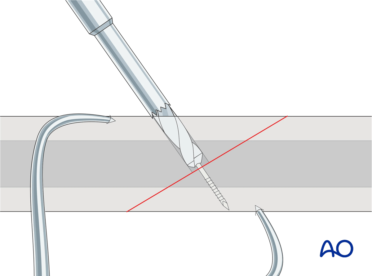 Insertion of cannulated screws