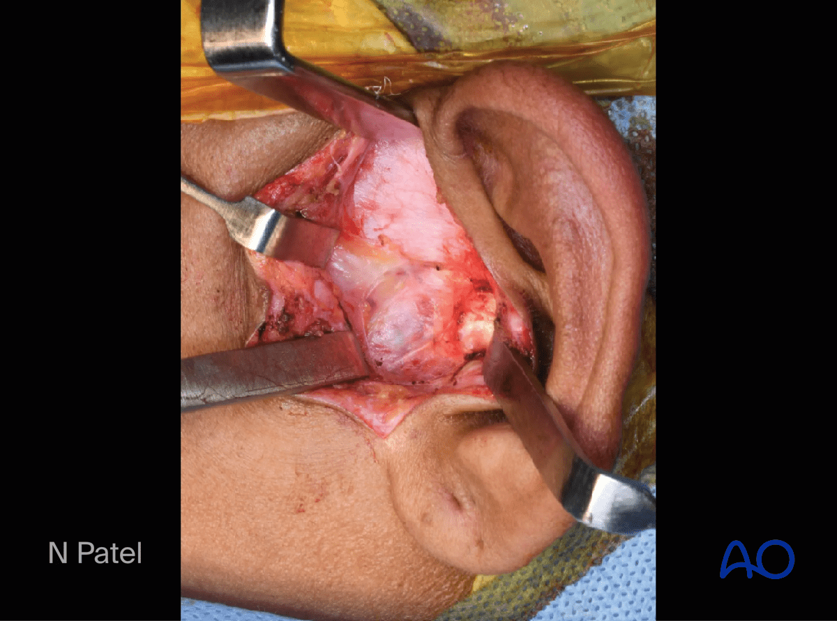 Endaural approach to condyle: Incise the overlying tissue to expose the root of the zygomatic arch