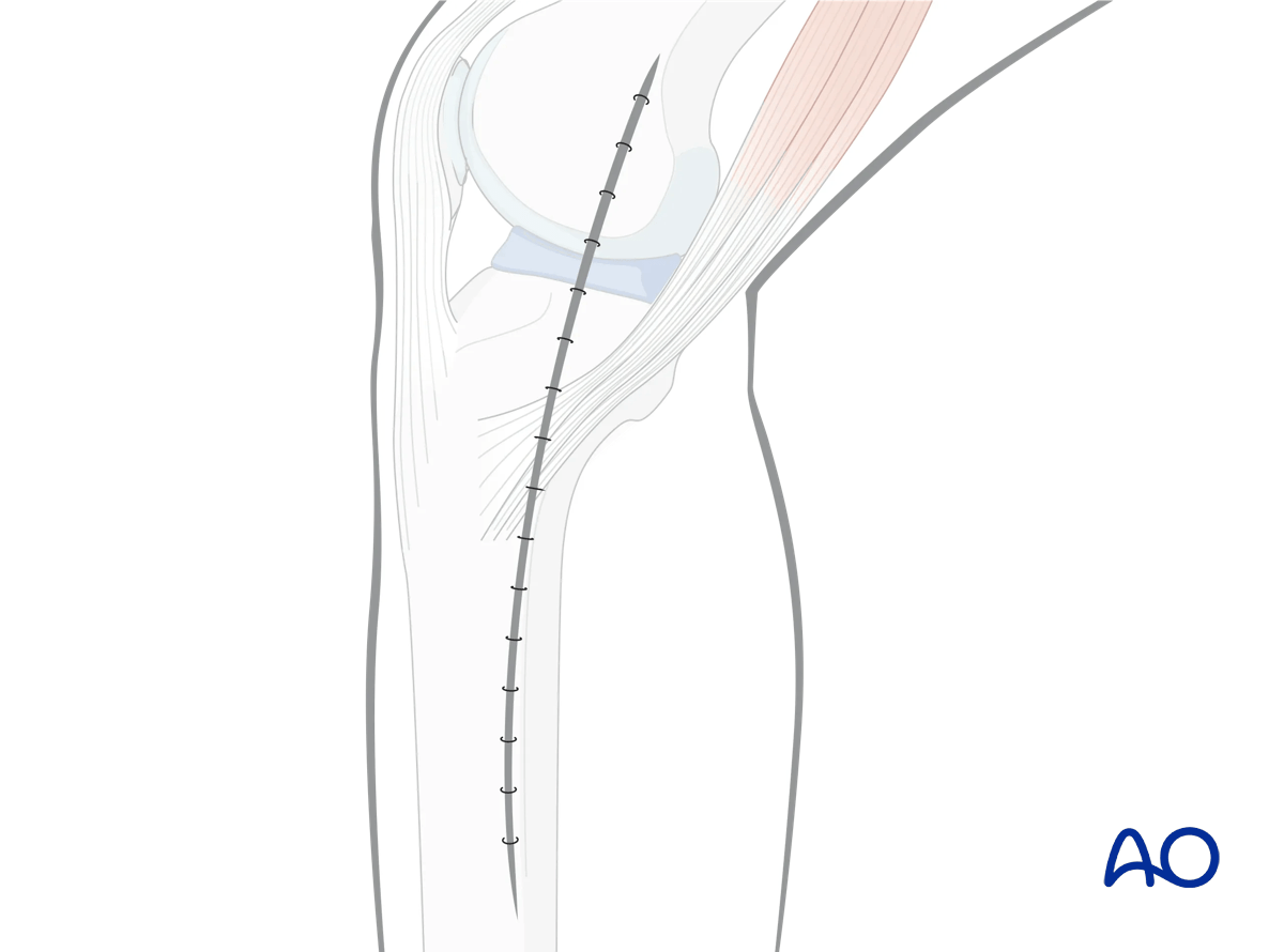 Medial/posteromedial approach to the proximal tibia, Wound closure