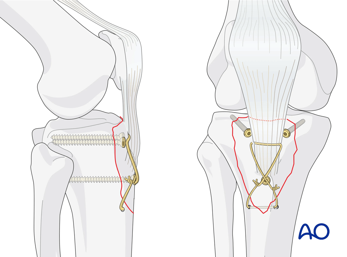 Avulsion of tibial tubercle: Lag screw application reinforced with a tension band wire