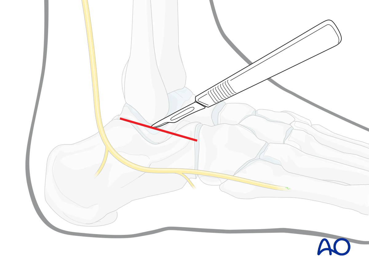 Sinus tarsi approach to the calcaneus incision from fibula tip to fourth metatarsal base