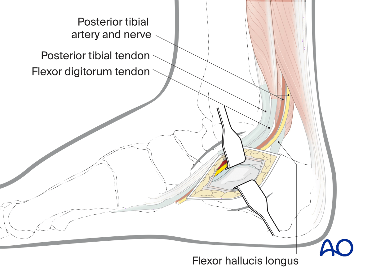 Deep dissection to sustentaculum tali in medial approach to the calcaneus